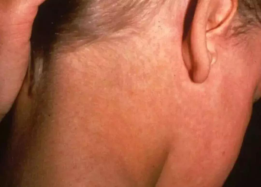 看图说病！专家提醒：立春后娃最易感染6种疹子，一定要认准了治