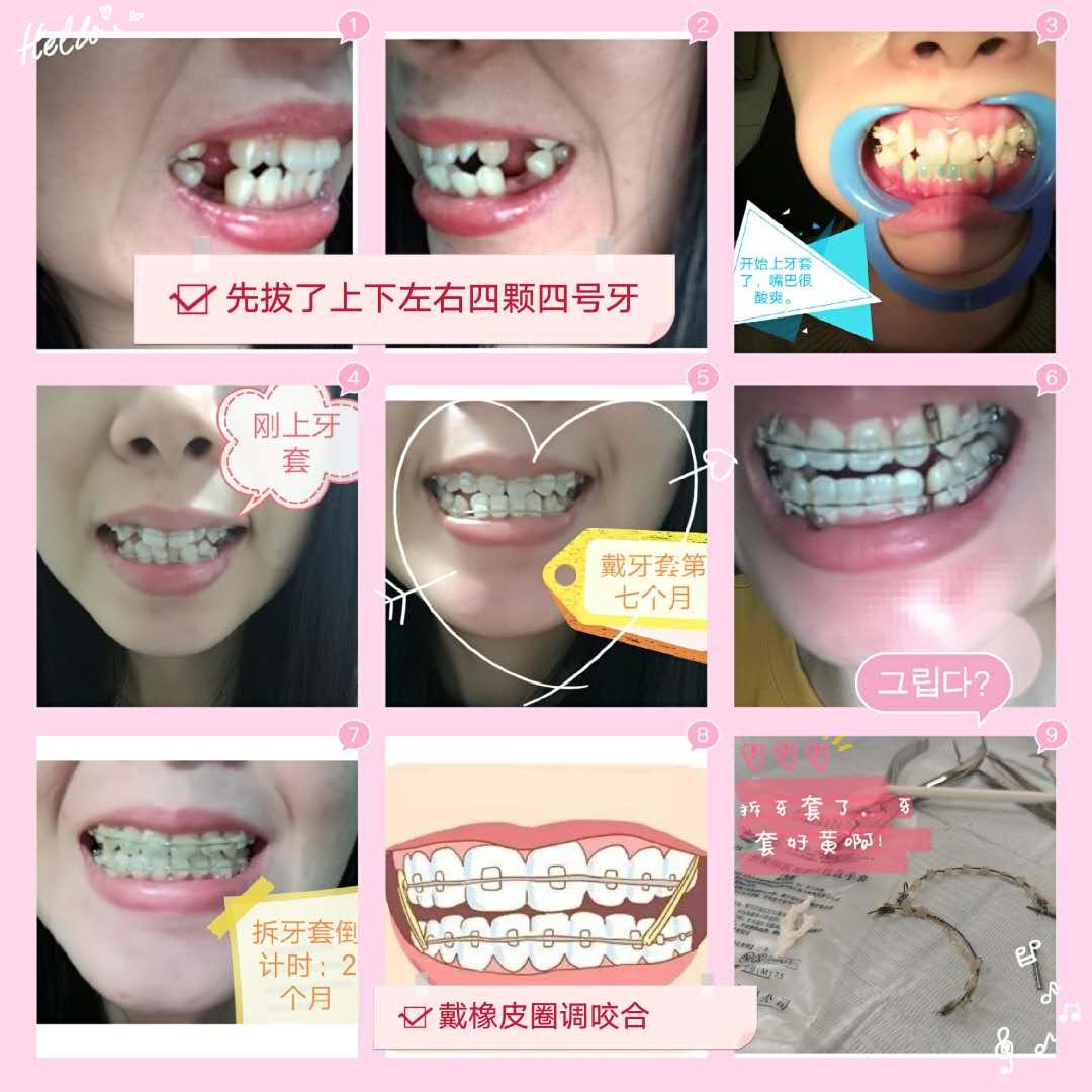 矫正经验分享,杭州口腔牙齿矫正