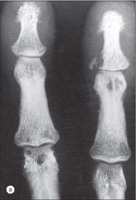 结节病关节痛眼睛模糊,结节病引起的关节炎