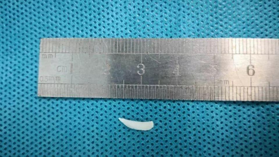 误吞鱼刺后喉咙隐隐约约刺痛,患者误吞鱼刺3小时不适首选检查