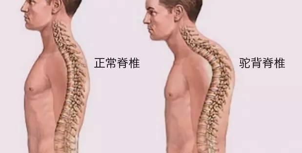 消除圆肩驼背正确坐姿,孩子圆肩驼背体态怎么纠正