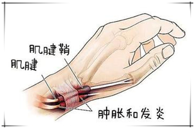 手指狭窄性腱鞘炎最快的恢复办法,手指狭窄性腱鞘炎怎么治疗小视频
