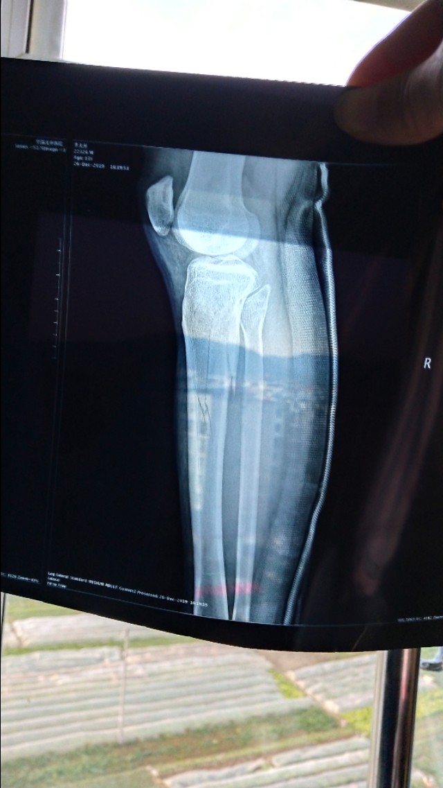 胫骨平台骨折复位不理想怎么办,胫骨粉碎骨折多久才会痊愈