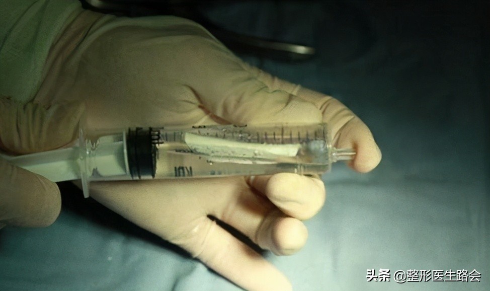 图解详示各种鼻整形方法及过程,鼻整形材料图