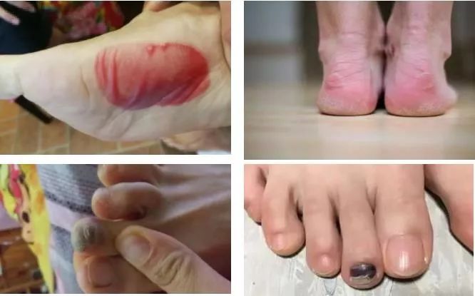 2019广马到来，穿最贵的跑鞋去跑马，脚有可能还是破皮……