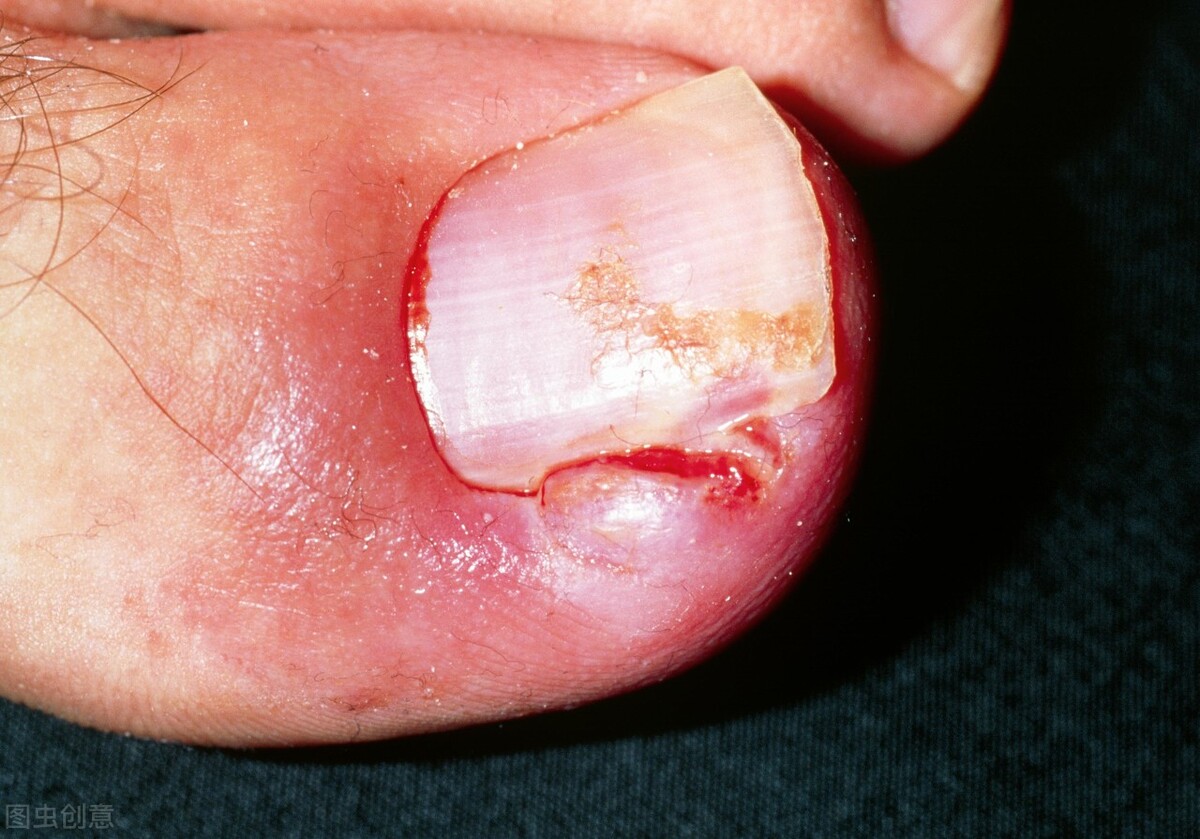 脚趾疼甲沟炎用药,甲沟炎引起脚趾痛怎么办