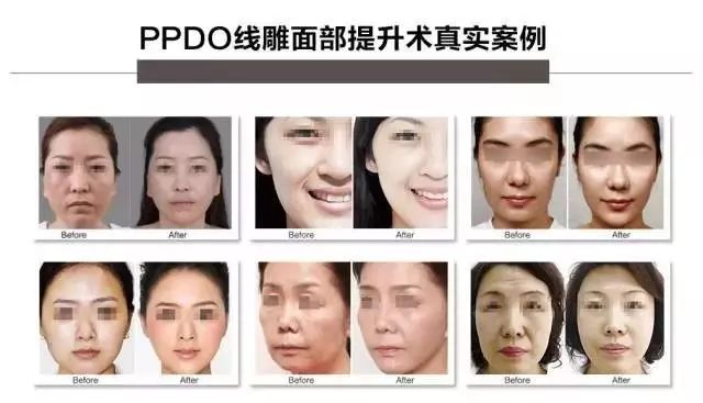 线雕第八天脸更大了,皮肤很松垮能做线雕吗