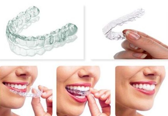 整牙用隐形牙套好还是用钢丝的好,钢丝牙套和隐形牙套哪个矫正快
