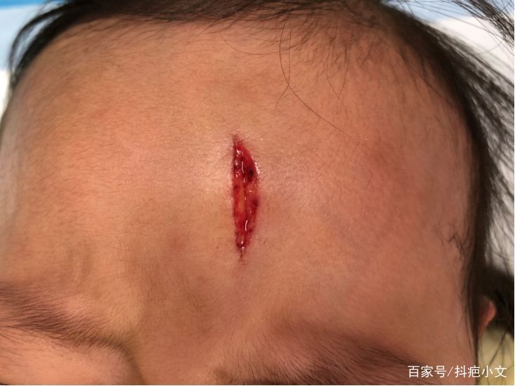 孩子不小心受伤了怎样问老师,孩子不小心摔伤怎么处理