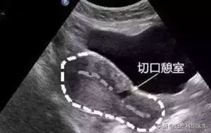 曝光月经失调七个真凶,怎么判断内分泌失调和月经有关