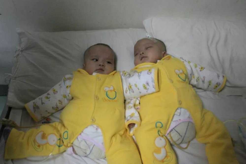 双胞胎坐骨连体成功案例,坐骨连体姐妹分离成功了吗