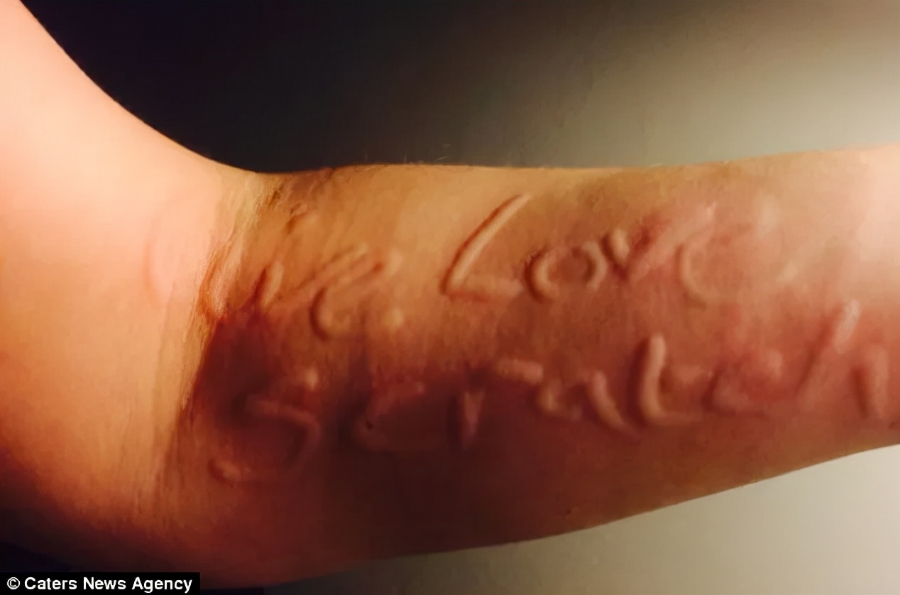 得了麻疹自己会好吗,得了荨麻疹会变成敏感肌吗