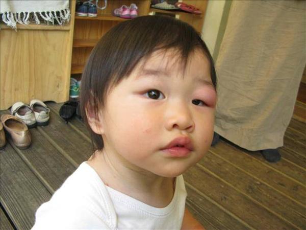 孩子被咬后,若呈现这些状况代表不是蚊子咬的包,别自行处理