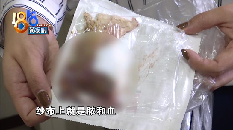 肛瘘纱布是扯出来的还是拉出来的,肛瘘手术后一直疼