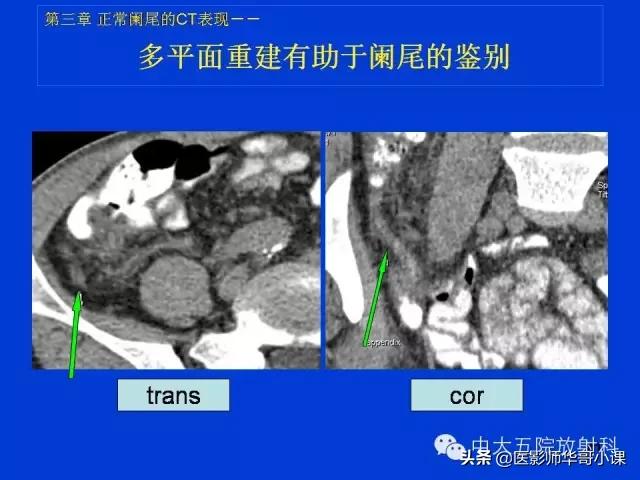 阑尾炎课件,阑尾炎的超声课件