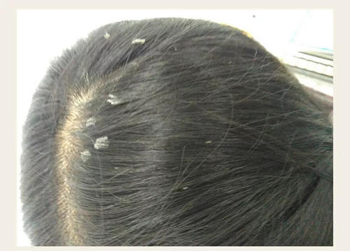 头上抠下来的淡黄色颗粒臭,头上抠下来的黄色小颗粒是什么