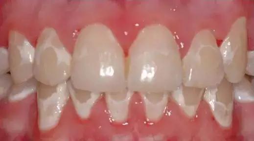 矫正牙齿是如何戴牙套的,矫正牙齿戴牙套需要注意事项