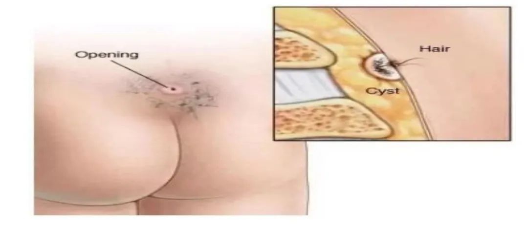 骶尾部藏毛窦真实经验,骶尾部藏毛窦多发于什么年龄