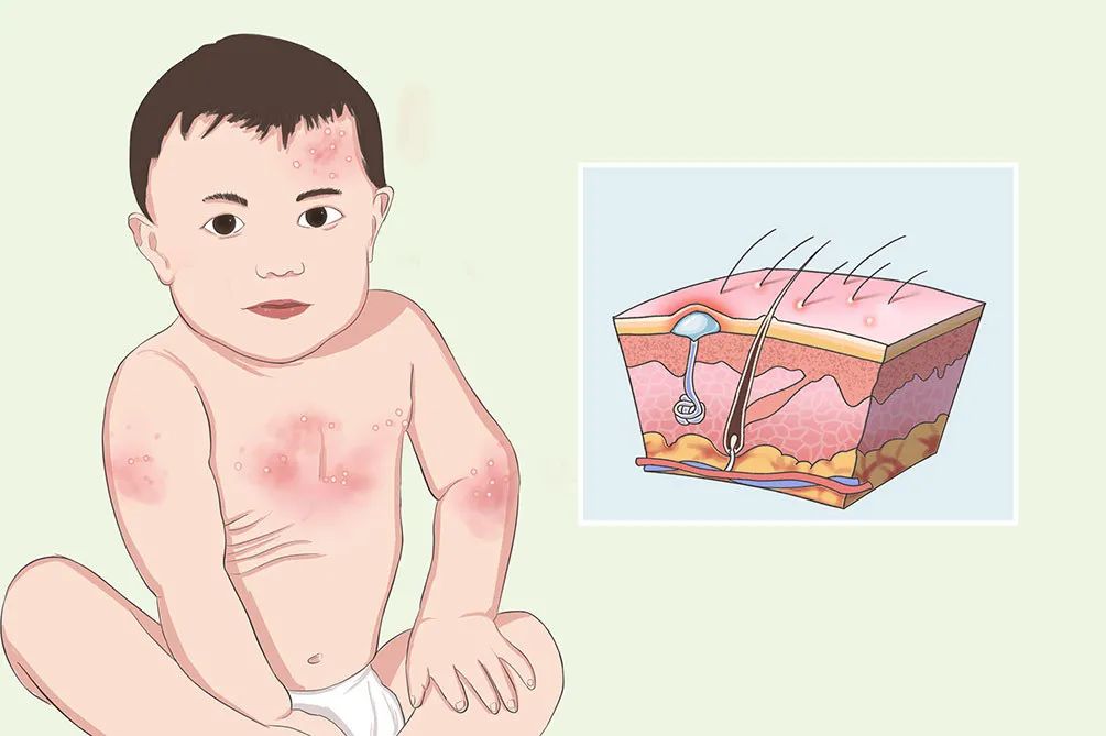 痱子和湿疹如何正确区分,怎么区分痱子和湿疹