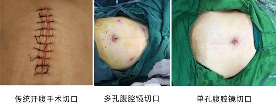单孔腹腔镜和微创区别,单孔腹腔镜庆松微创