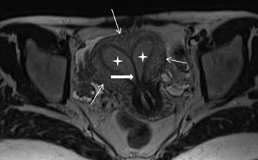子宫内什么管短容易流产,子宫特别小还有必要治疗吗