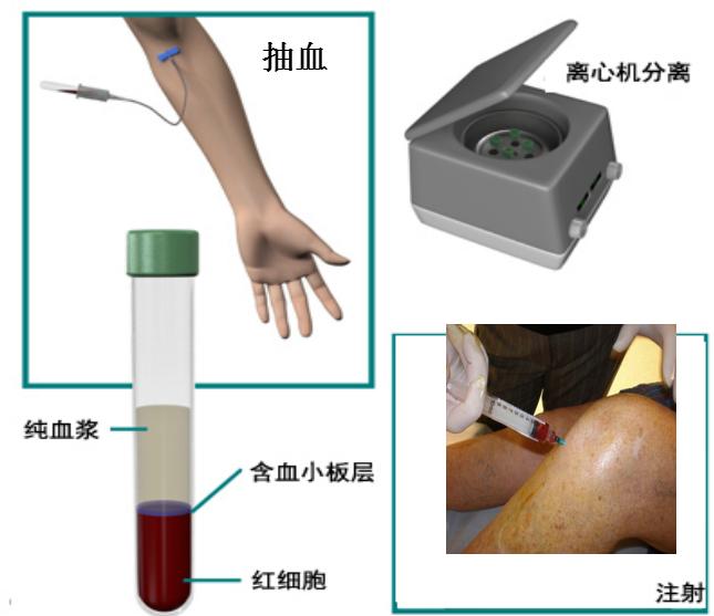 膝关节骨性关节炎症状及治疗,膝关节骨性关节炎诊疗指南下载
