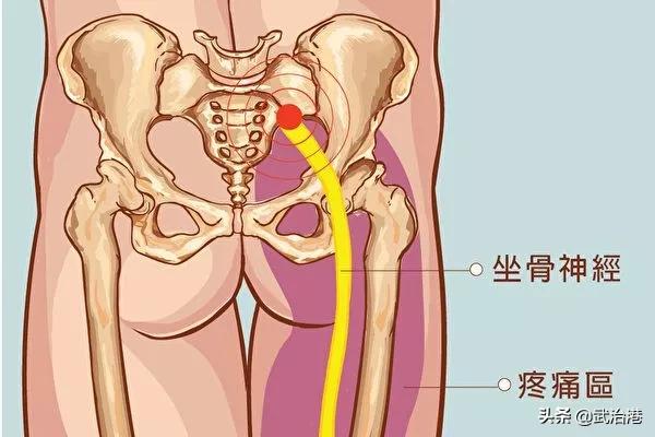腰椎间盘突出全国有多少人,腰椎间盘突出别担心90%都能恢复