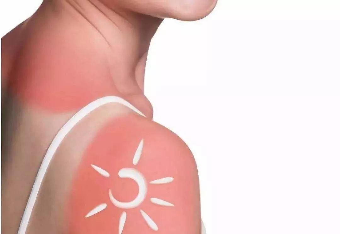 被晒伤后脱皮怎么修复,晒伤皮肤有黑斑怎么恢复