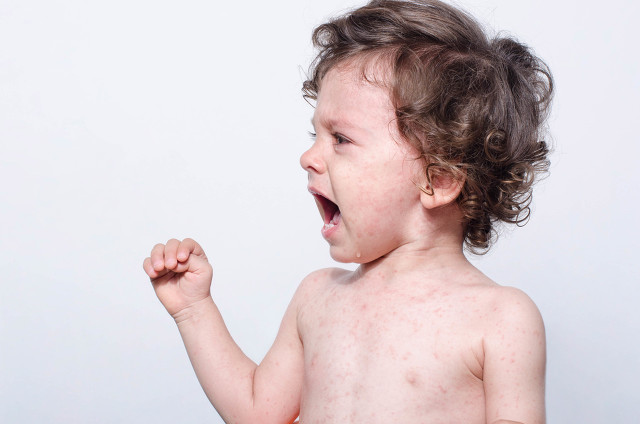 夏天儿童容易出痱子怎么办,夏季孩子起热痱子怎么办