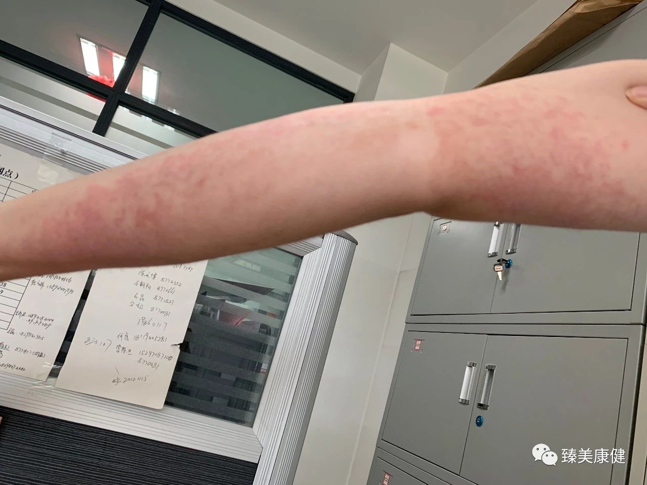 胃苓丸加什么药治湿疹,除湿胃苓丸治疗湿疹