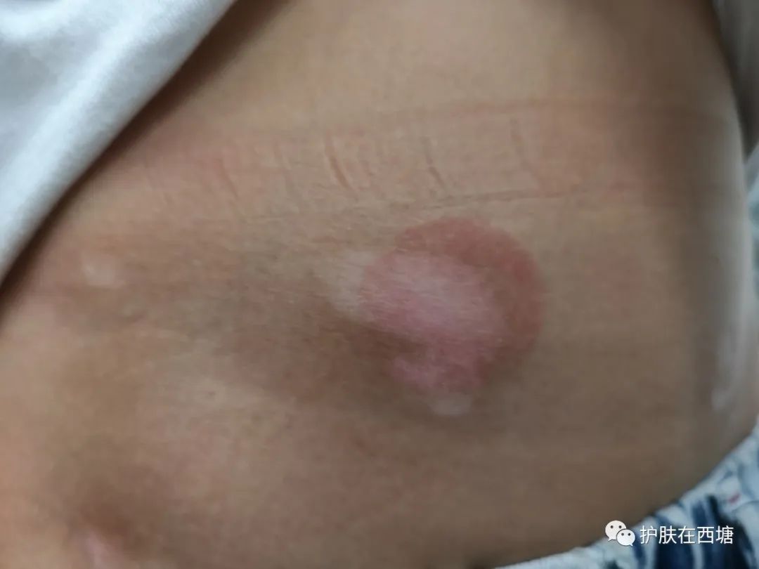 白癜风是个什么,白癜风到底是什么