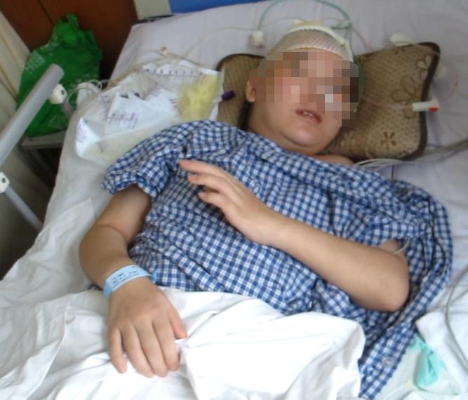 脑室有粘连脑积水有什么办法,脑动脉畸形手术后出现急性脑积水