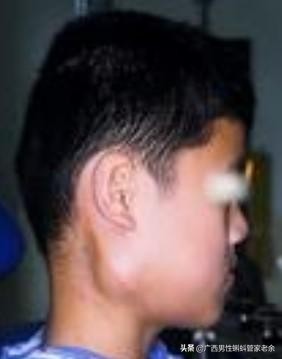 猪头肥是腮腺炎吗,你小时候得过腮腺炎吗