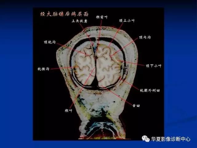 电子版头颅ct与mri断层解剖,头颅mri血管解剖与分段详解