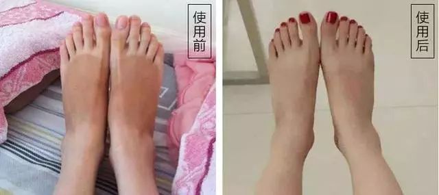 夏天了手脚干裂还有老茧,手脚干裂脱皮老茧用什么药膏