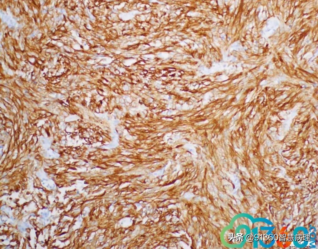 宫颈腺癌silvaa型用化疗吗,宫颈腺癌silvab型需要放疗几次