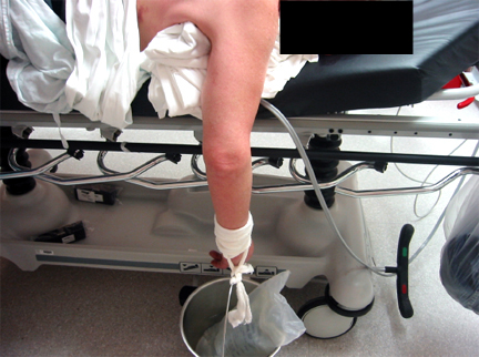 骨科脱臼恢复手法视频,肩膀脱臼复位视频成人