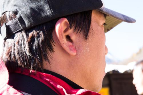 晒伤了发红发烫怎么快速修复变白,太阳晒伤是怎样的