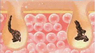 去黑头方法让黑头再也长不出,黑头太顽固教你去黑头的方法