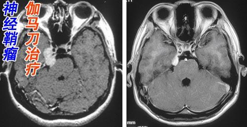 放疗和化疗的区别哪个更严重,放疗化疗是什么两者之间有何不同