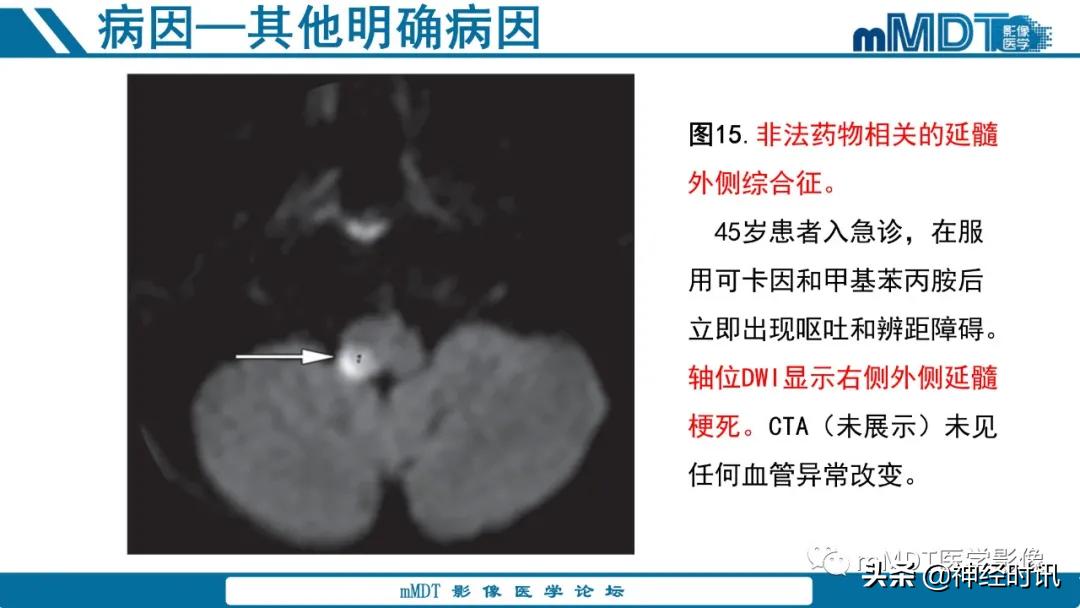 急性缺血性脑卒中ppt素材图片,青年缺血性脑卒中ppt