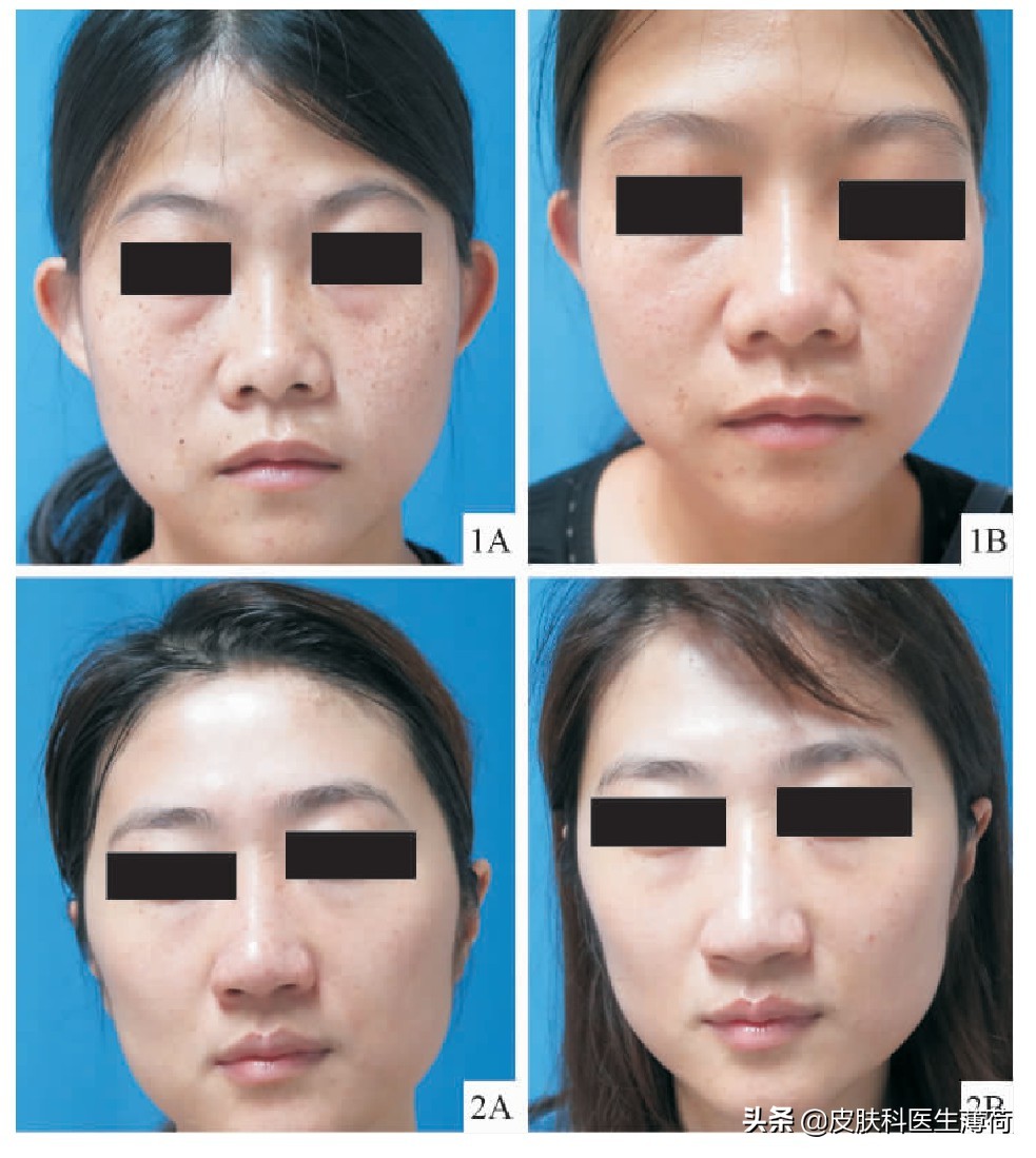 祛斑祛红色痘印激光,点阵激光祛斑仪器