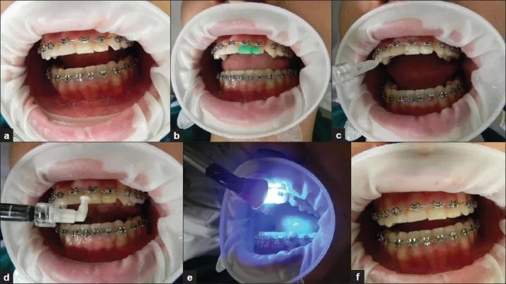 牙齿脱矿涂氟多久可以恢复,牙齿脱矿白斑能自己恢复吗