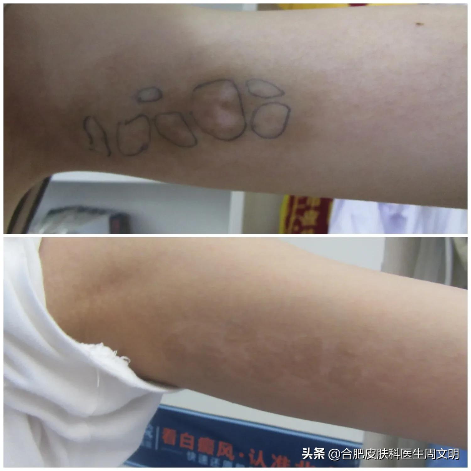 女性白癜风长在大腿内侧难治吗,为什么说白癜风离心脏越远越难治