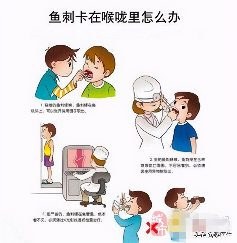 误吞小鱼刺怎么处理,误吞鱼刺总感觉胃里不舒服