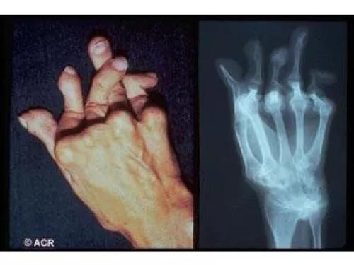 类风湿性关节炎和老寒腿一样么,老寒腿风湿关节炎