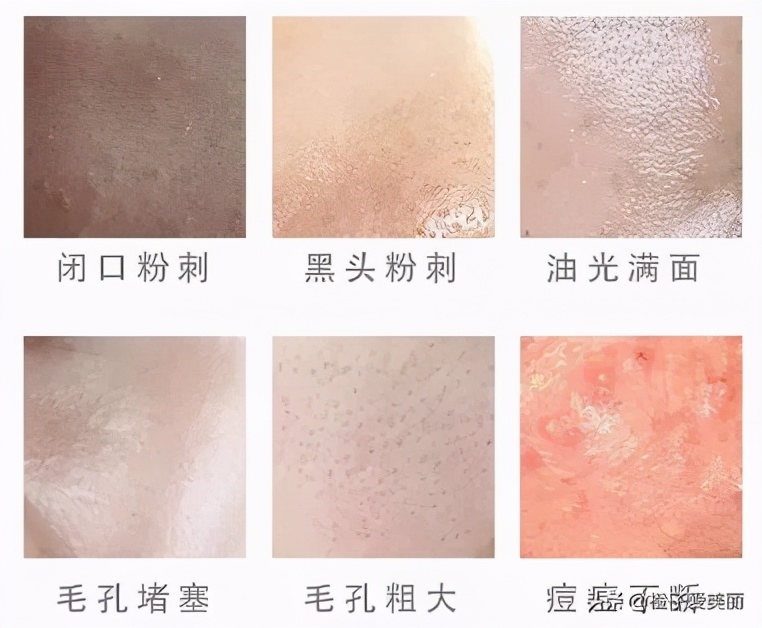 敷尔佳水杨酸果酸换肤测评,博乐达水杨酸和达尔肤面膜