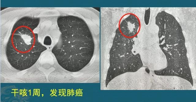 癌症发现就是晚期还有必要体检吗,有些癌症不治没事一治就完了