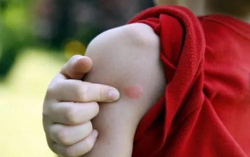 孩子容易被蚊子咬怎样防蚊有效,宝宝总被蚊子叮怎么预防