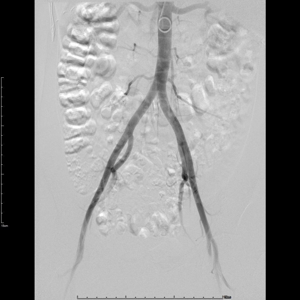 囊性子宫腺肌病的特点是什么,囊性腺肌病最佳治疗方案